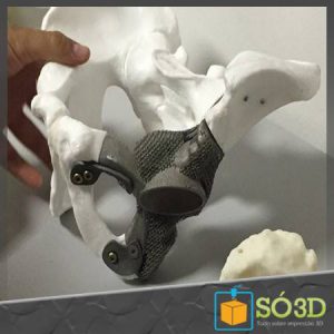 Implantes de quadris feitos em impressora 3D prometem maior desempenho