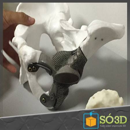 Implantes de quadris feitos em impressora 3D prometem maior desempenho<