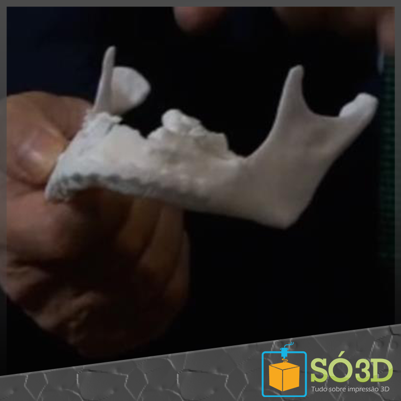 Cirurgião consegue reconstruir mandíbula quebrada de paciente com a ajuda de impressoras 3D<
